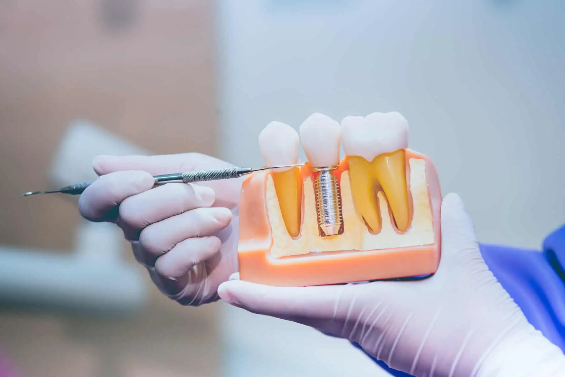 Dental implant