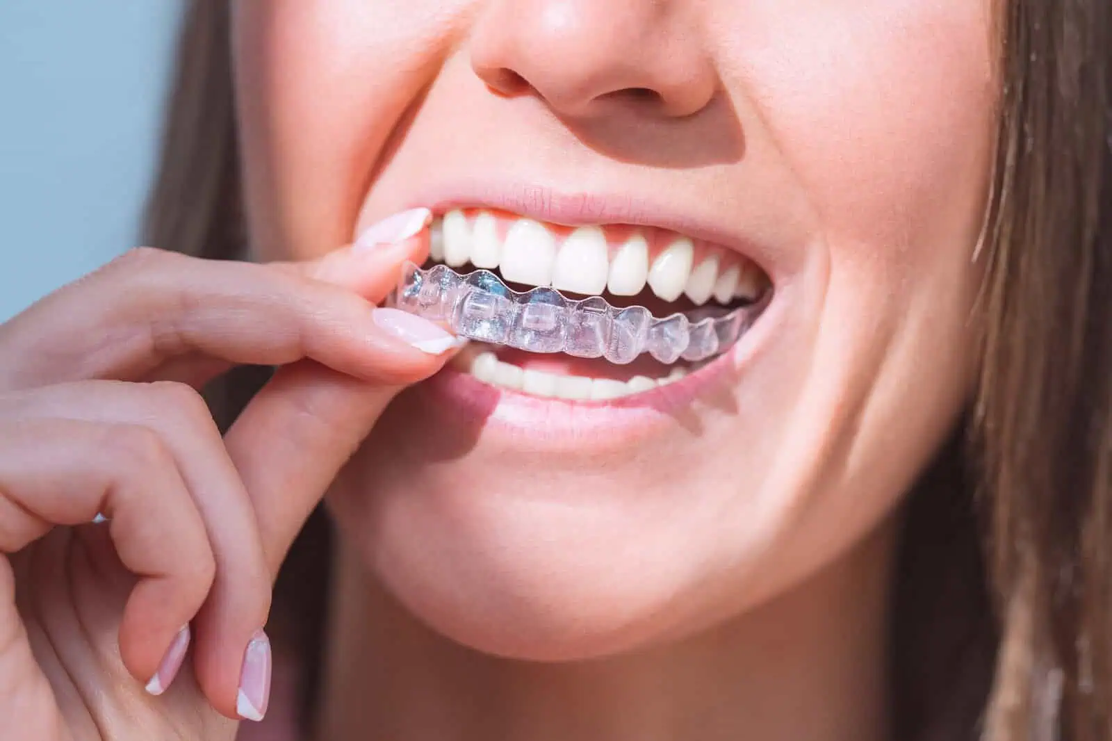 A set of Invisalign clear aligners