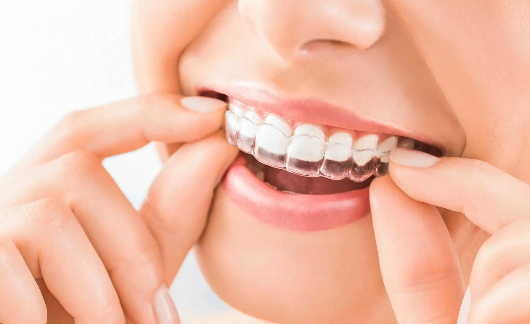 Invisalign clear aligners
